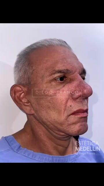 Transformación de lifting facial — video de antes y después de lifting facial