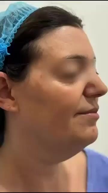 Transformación de lifting facial — video de antes y después de lifting facial