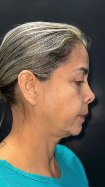 Transformación de lifting facial — video de antes y después de lifting facial