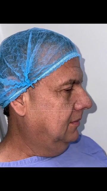Transformación de lifting facial — video de antes y después de lifting facial