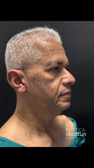 Transformación de lifting facial — video de antes y después de lifting facial