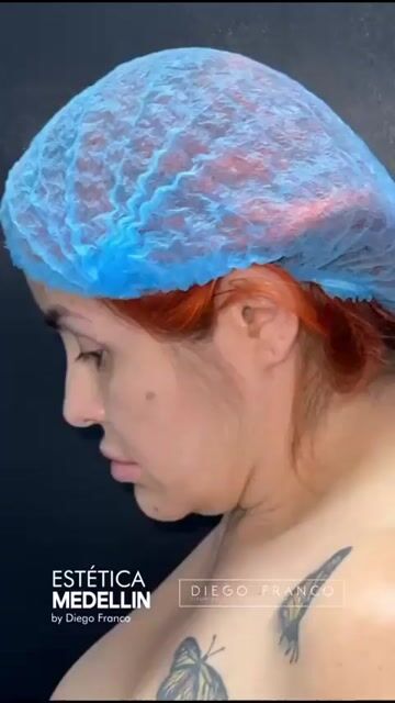 Transformación de lifting facial — video de antes y después de lifting facial