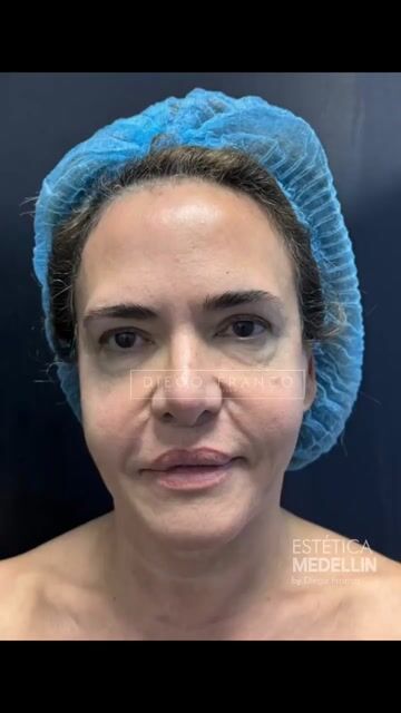 Transformación de lifting facial — video de antes y después de lifting facial