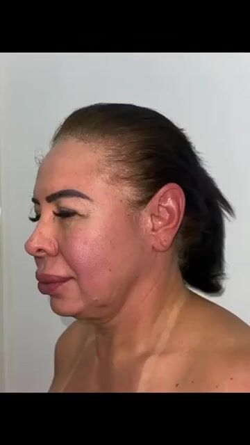 Transformación de lifting facial — video de antes y después de lifting facial