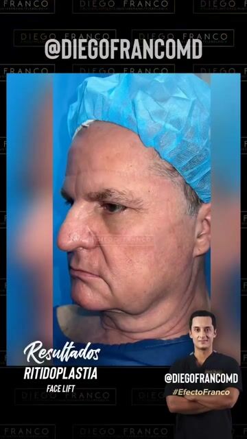 Transformación de lifting facial — video de antes y después de lifting facial
