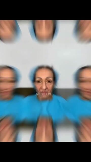 Transformación de lifting facial — video de antes y después de lifting facial